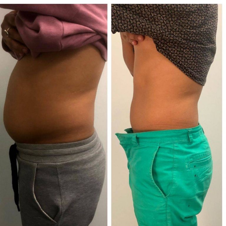 cryoskin-body-slimming-before-after-1