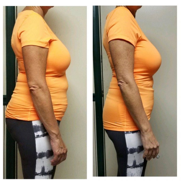 cryoskin-body-slimming-before-after-2